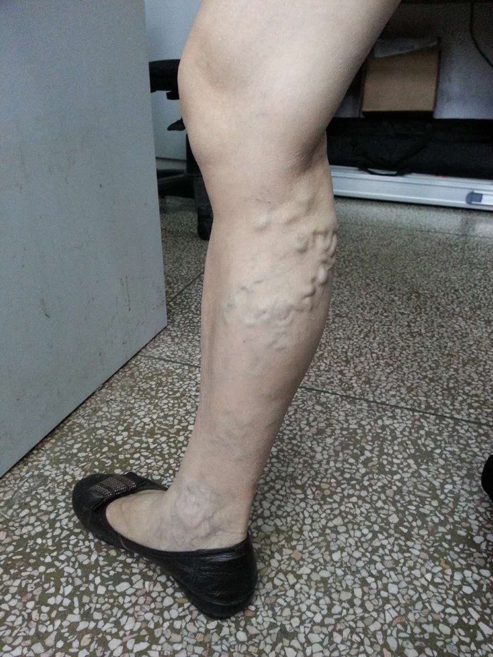 下肢静脉曲张是外科的常见病多发病之一,早期无不适症状,往往被忽视