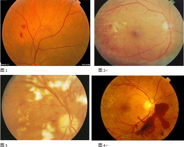 牵拉性视网膜脱离,合并纤维膜,可合并或不合并玻璃体积血,也包括虹膜