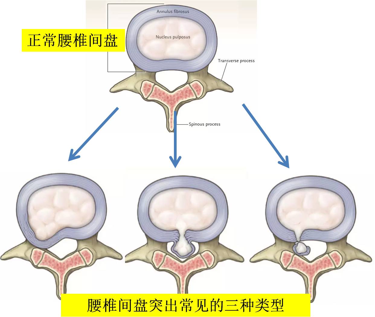 图1 腰椎间盘突出型,脱出型和游离型,均可以压迫神经一