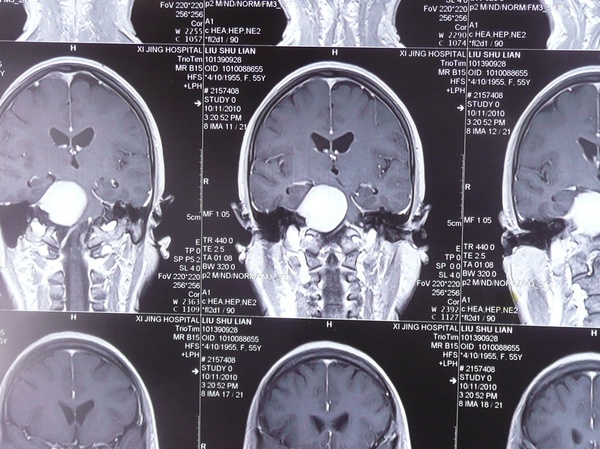 贺晓生教授:岩骨斜坡区脑膜瘤手术实例视频
