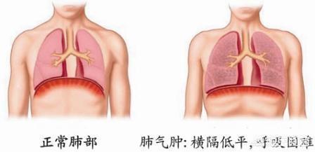 正常的肺和肺气肿图片图片