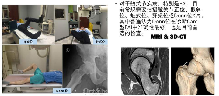髋关节撞击综合征fai需要手术吗