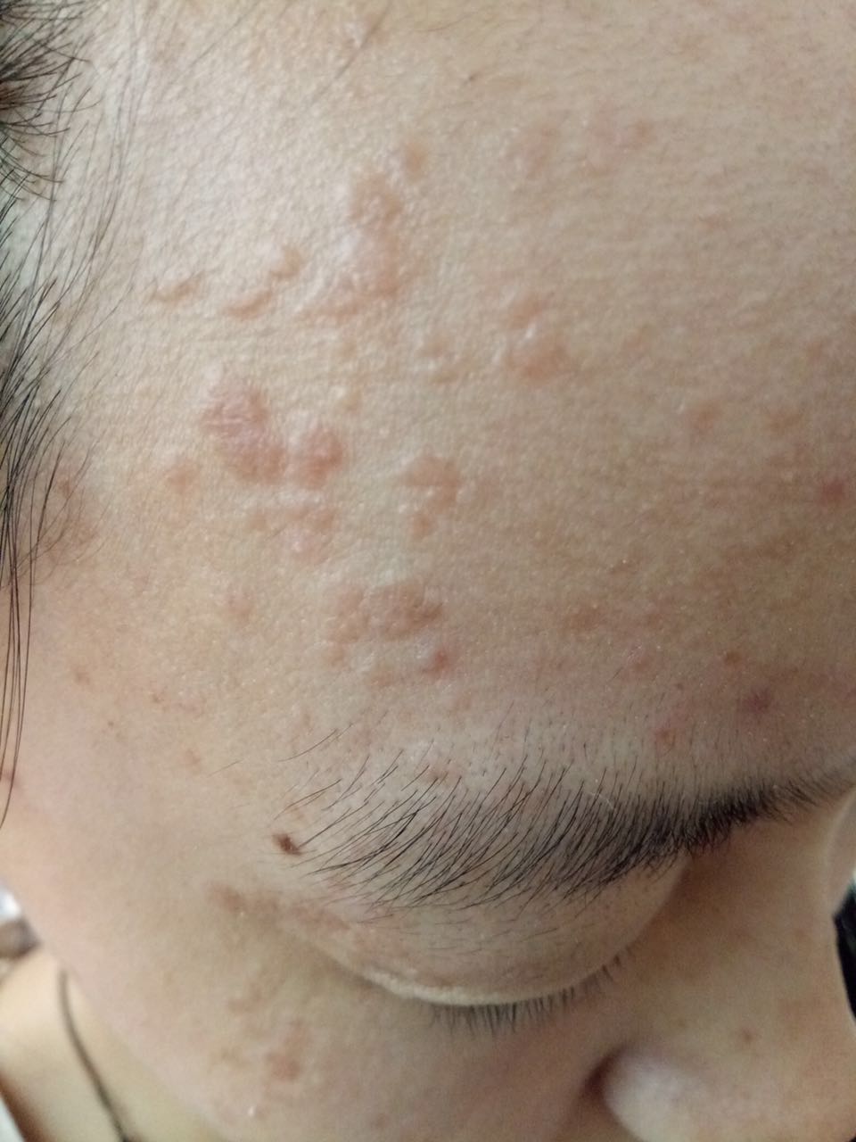 是什么原因导致扁平疣出现