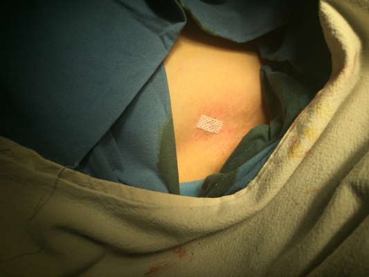 手汗症住院手术详细流程——2017年9月16日