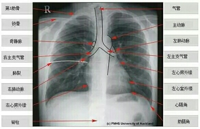 正常胸片中,清晰可见纵隔边缘,偏侧膈边缘,和心脏后的血管;膈和心膈角