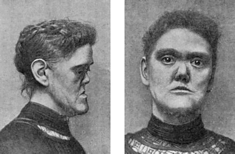 三期梅毒疹(鞍鼻)