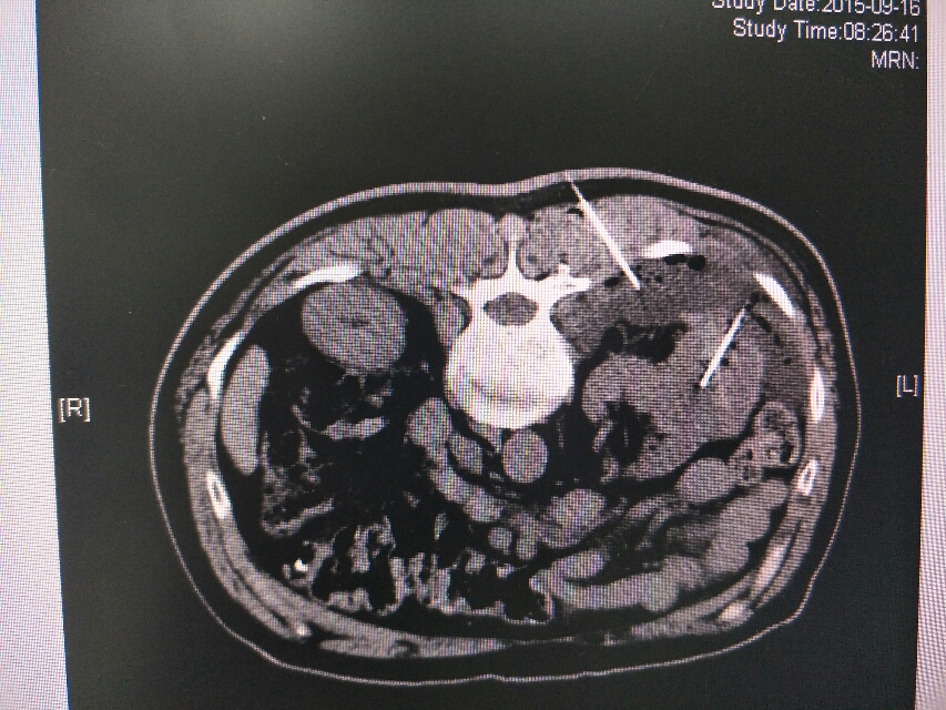 肾癌化疗及靶向治疗效果差,后予射频消融手术