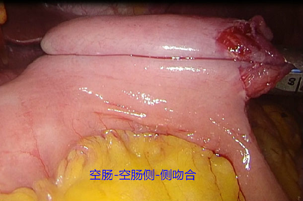 完全腹腔镜下近端胃大部切除术(双通道消化道重建)