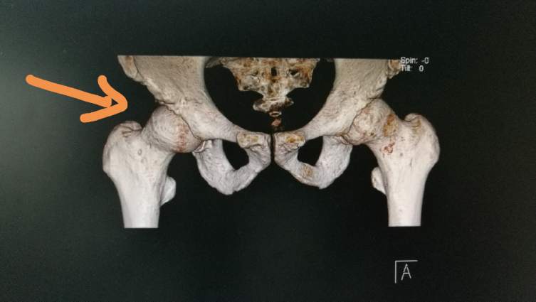 56歲男性,雙髖關節撞擊徵,右側疼痛較重準備手術,術前ct顯示槍柄畸形