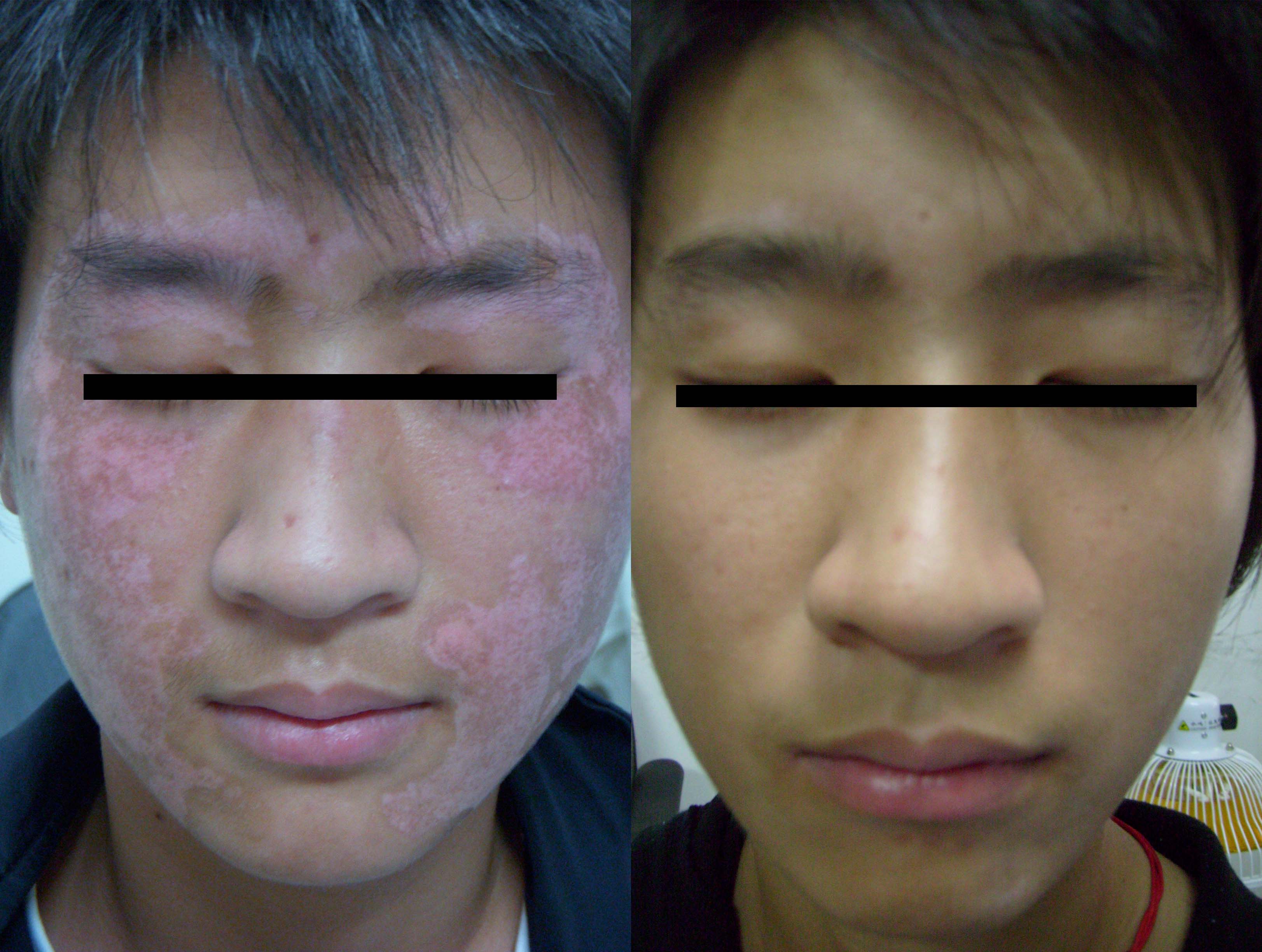 发病初期白癜风症状轻,患者脸部皮肤上的白斑数量以及面积都不多,皮损