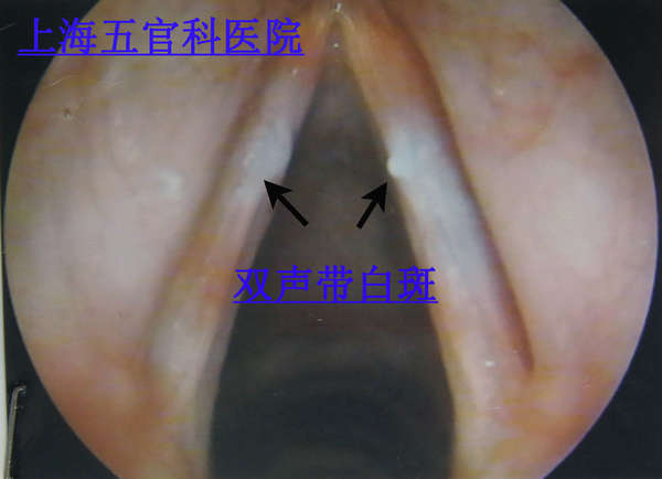 声带白斑