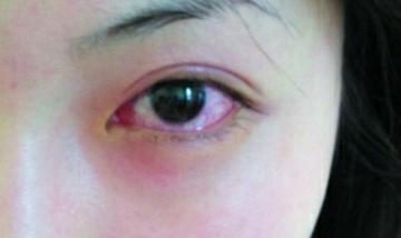 真相眼红就是红眼病吗