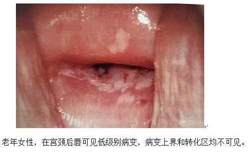 醋酸白上皮单独存在时不具有诊断特性,根据醋酸白上皮来可以