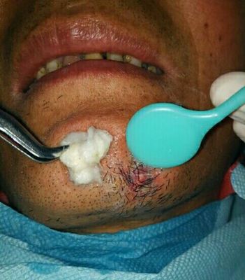 牙病引发皮瘘(误诊)一例