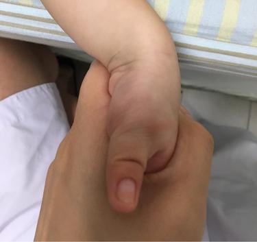 拇指内扣怎么办只需123