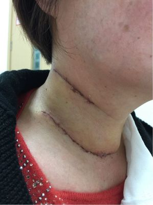 甲状腺乳头状癌术后颈淋巴结转移的再次手术