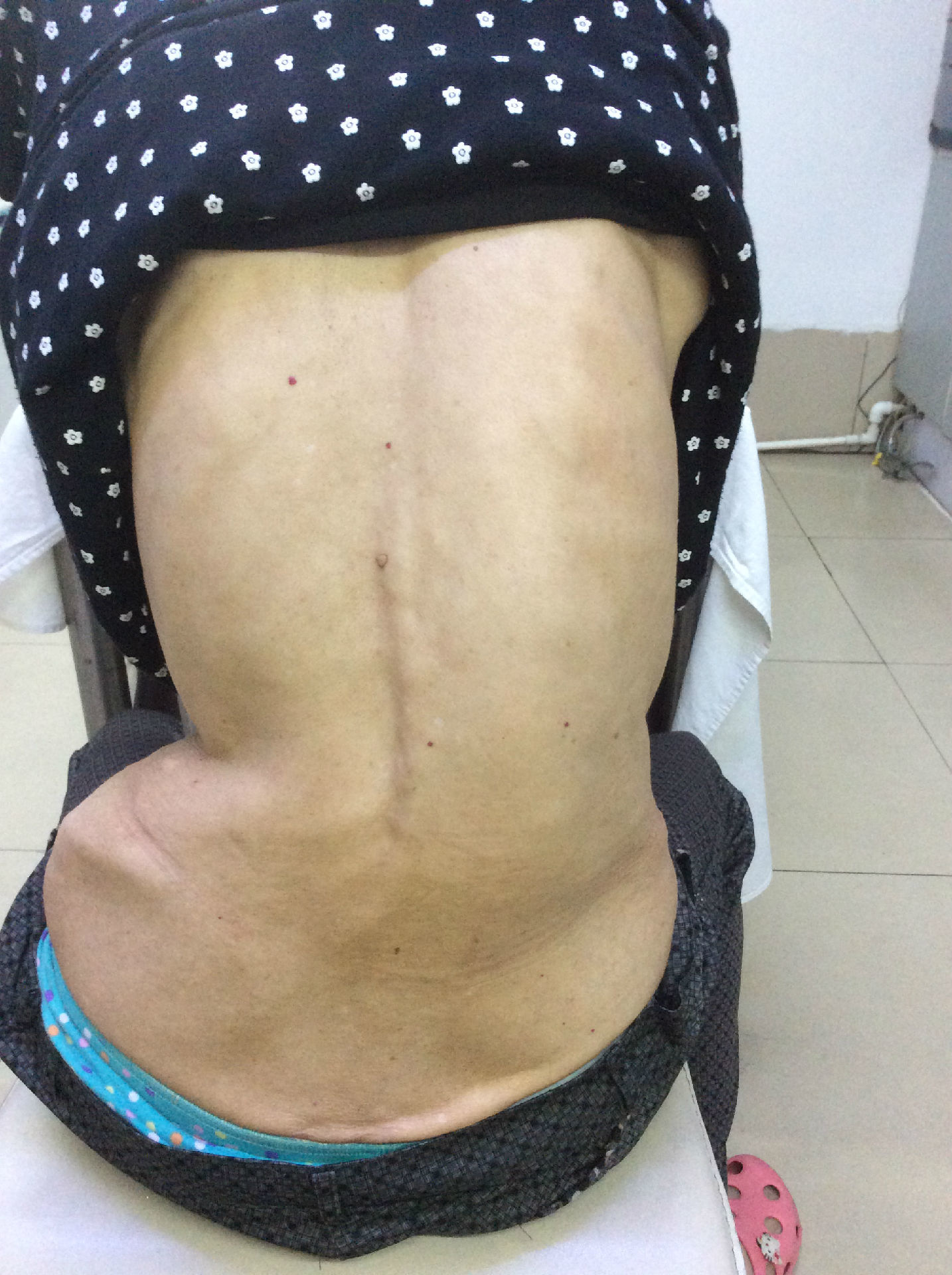 脊柱弯曲的自我评定方法