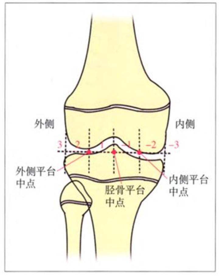 儿童矫形8字钢板半骺阻滞术治疗儿童膝外翻畸形