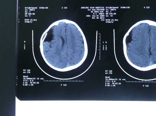 术后一年复查ct(2013-06-02:分流管脑室端位置良好,囊肿进一步