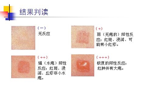 斑贴试验(接触过敏源测试)简介