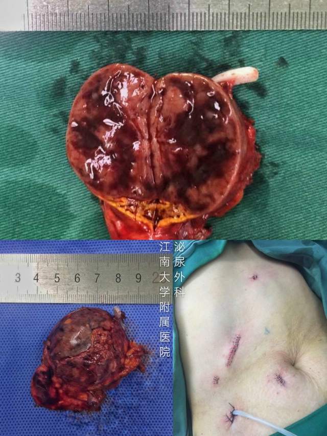 该患者手术顺利,经腹腔途径行右肾上腺肿瘤切除,过程顺利,患者恢复