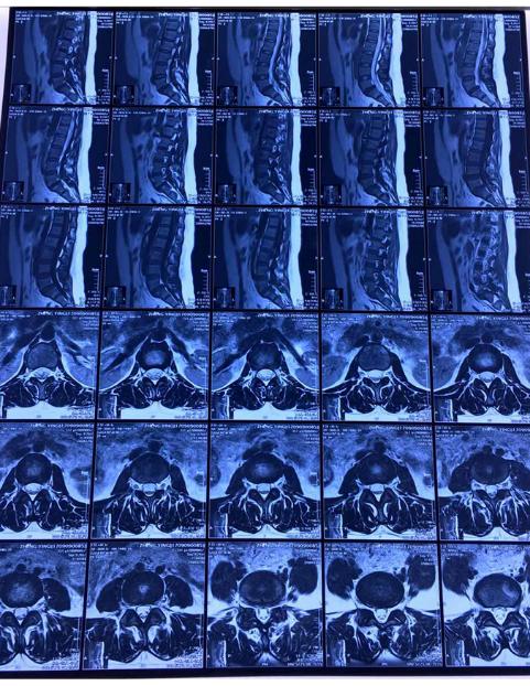 峡部裂导致腰椎滑脱该怎么治疗?