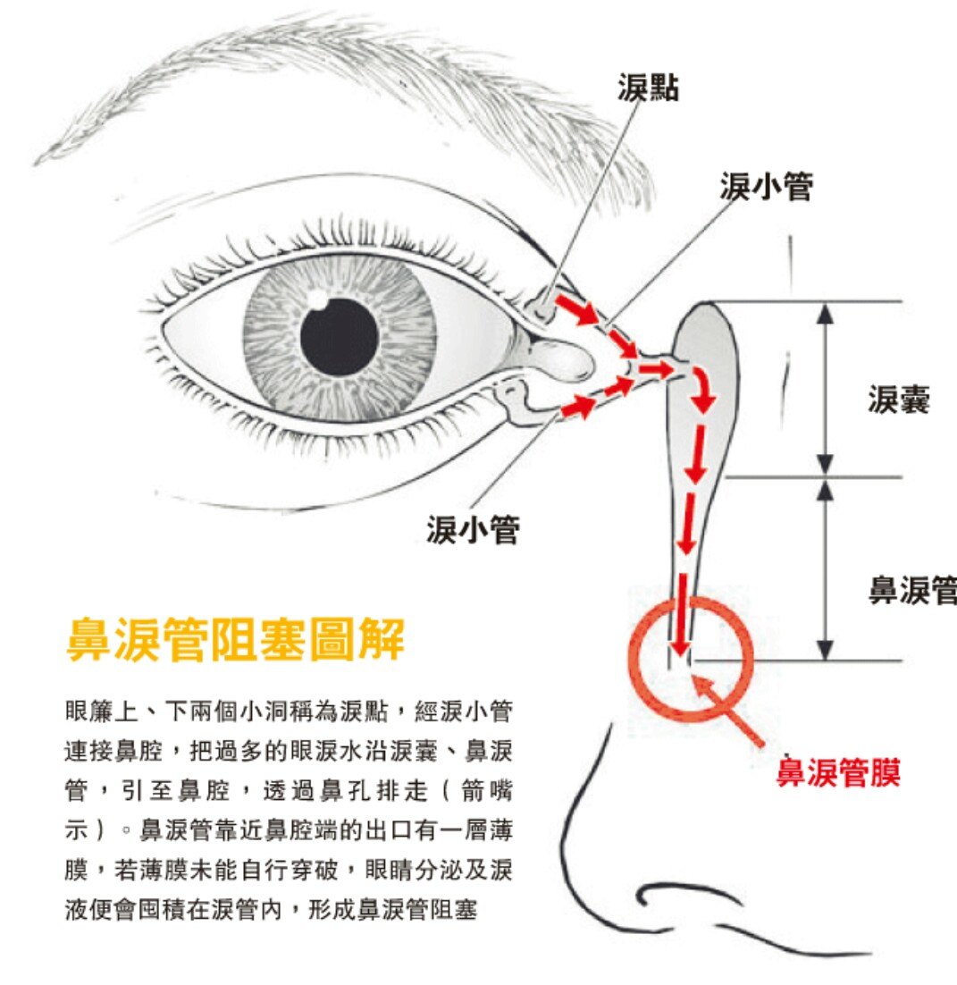情况下宝宝是出生后不久就有流眼泪现象,有些不容易引起家长的重视