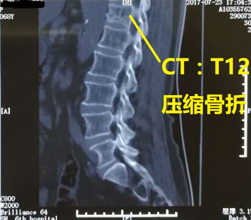 腰椎第一节压缩性骨折图片