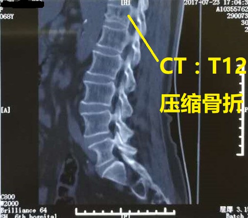 l1腰椎压缩性骨折图图片