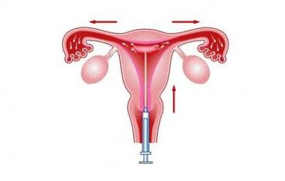 人工授精和试管婴儿,应该如何选择?