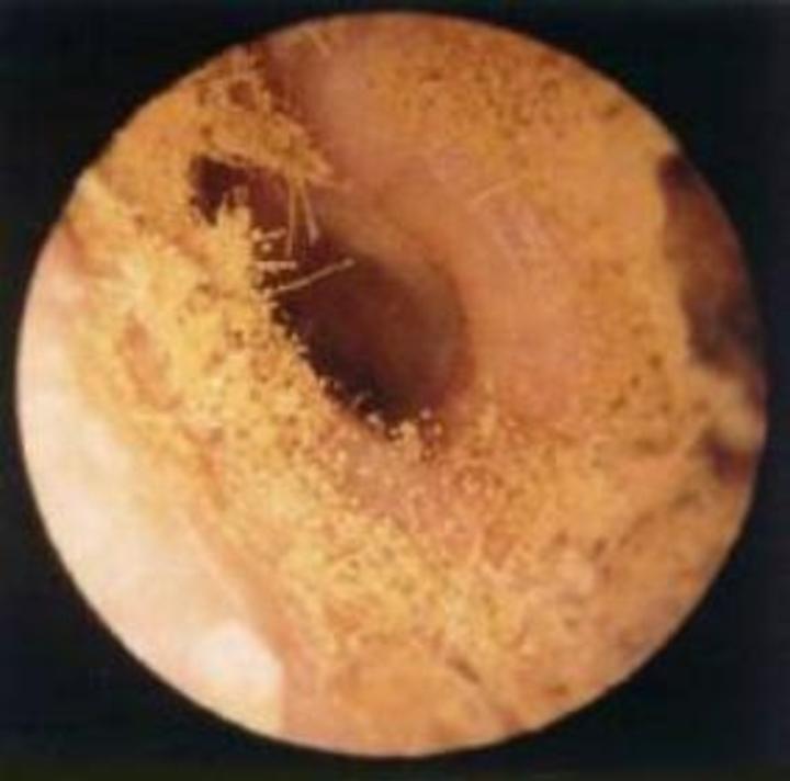 山东省立第三医院耳鼻喉科医学科普常识--外耳
