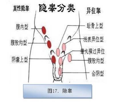 隐睾又称睾丸下降不全(图17),是指睾丸未降至阴囊内,而停留在下降