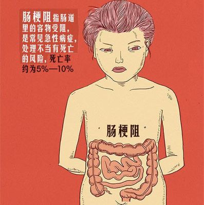 肠梗阻患者不能做腹腔镜手术吗—肠道支架再通生命之道
