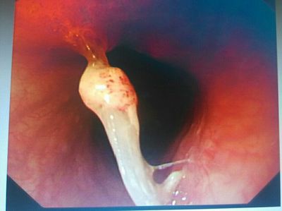 误食鱼刺,内镜取出