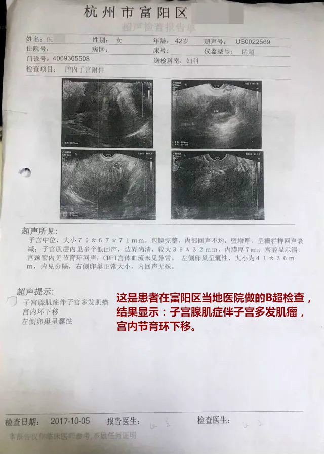 2000年流产过一次,七年前查出子宫腺肌症,有宫颈糜烂史,子宫肌瘤,但