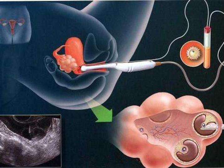 人工授精就医指南