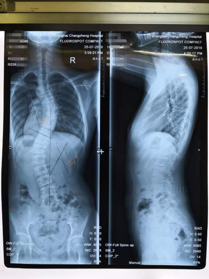 小科普青少年脊柱侧弯