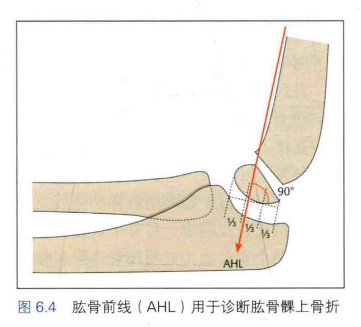 該患兒肱骨髁上骨折診斷明確,正位片存在內翻成角,側位片存在後方成角