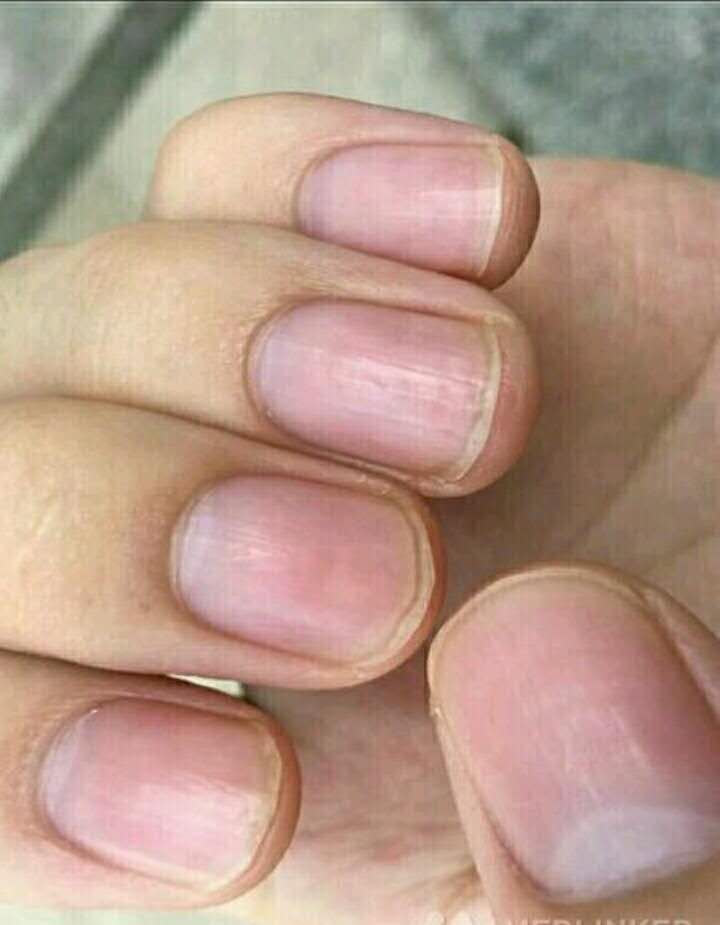 指甲竖纹或分叉,气血失畅之信号 - 微医(挂号网)