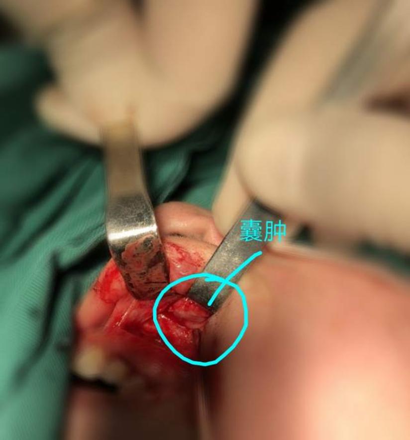 病案纪实 鼻前庭囊肿 健康号 微医