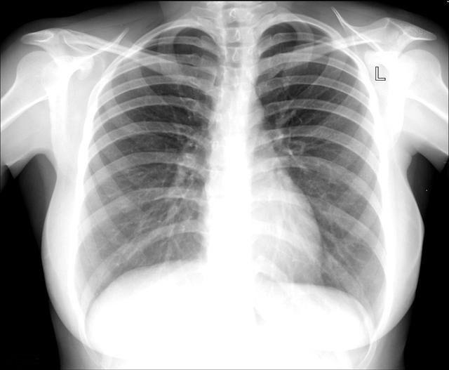 胸片能诊断肺癌吗?为什么非得做昂贵的CT及很