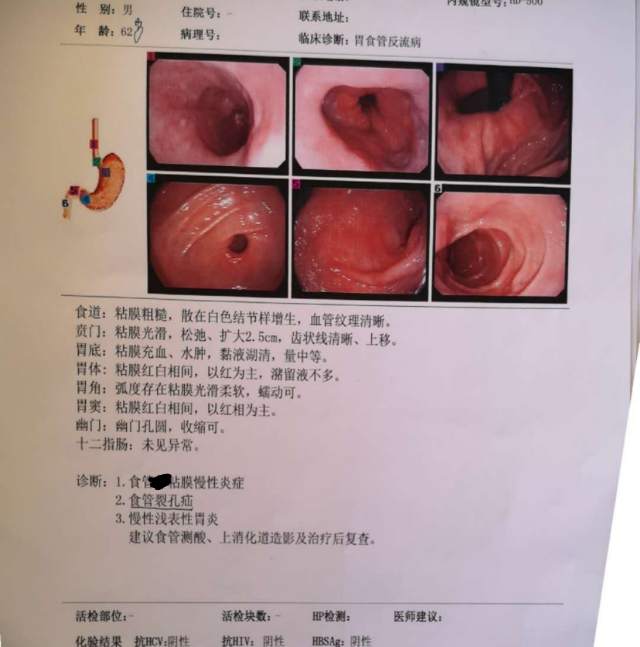 食管裂孔疝内镜图片分享 - 微医(挂号网)