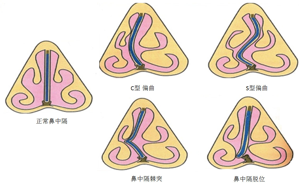 鼻中隔偏曲