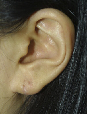 耳垂裂手术缝合的照片图片