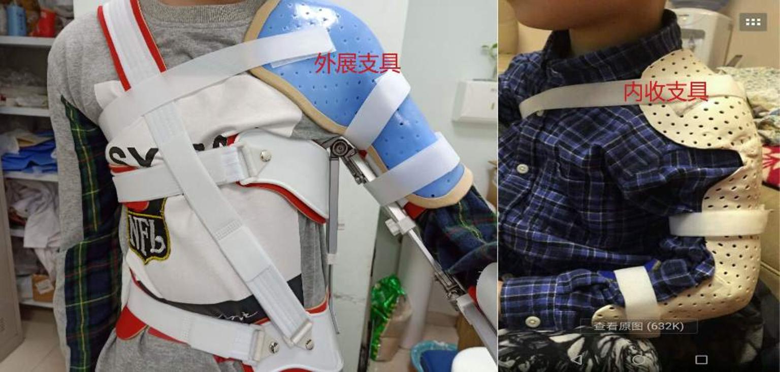 儿童骨折塑形能力强,是不是所有骨折都可以保守治疗呢_小儿骨折_介绍