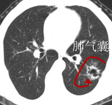 肺里长泡泡了怎么办