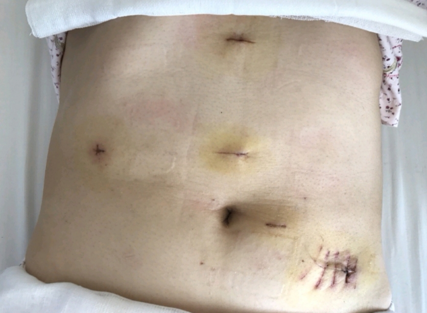 巨脾合并胆囊结石,一次搞定!