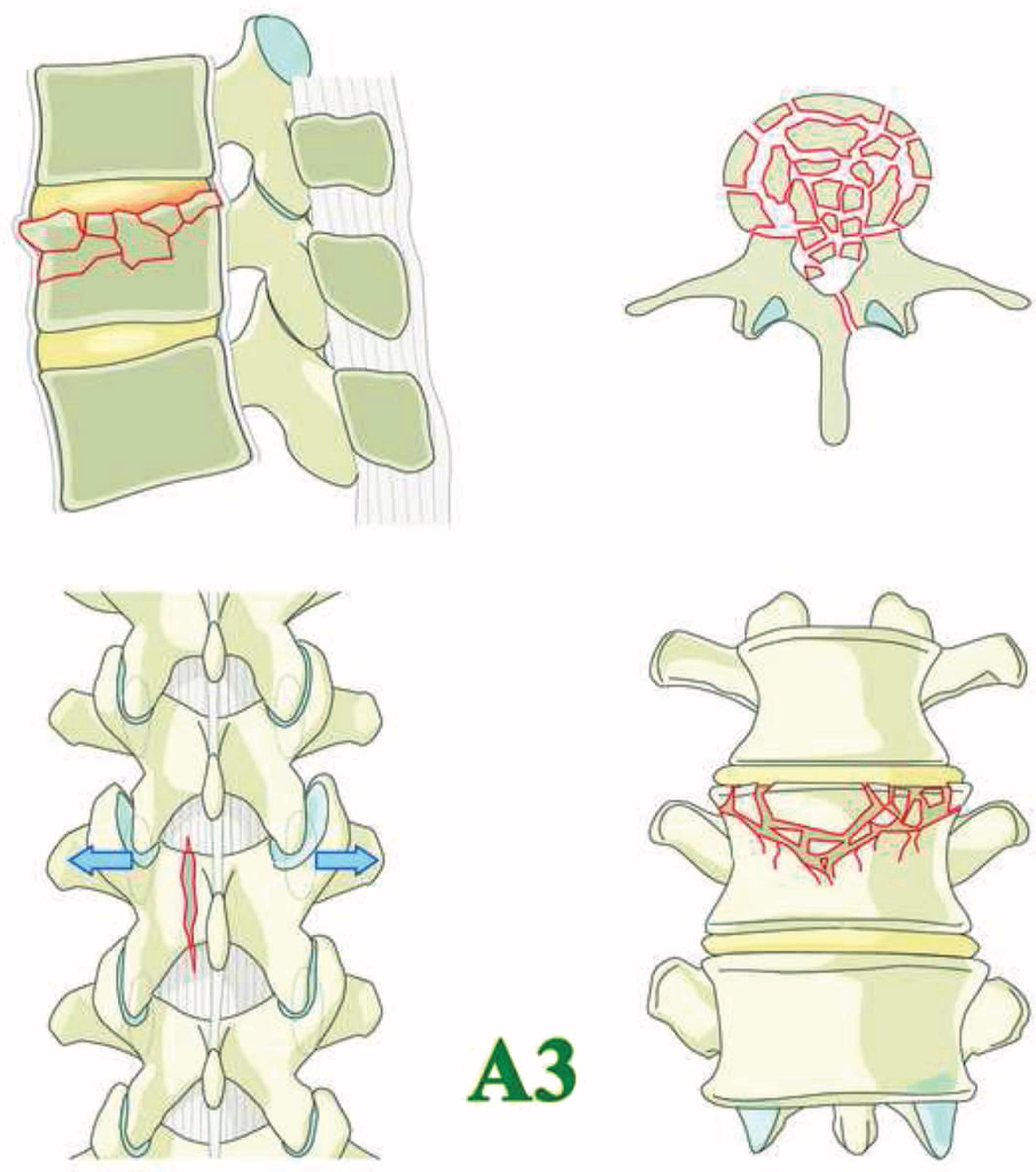 a3亚型-不完全爆裂骨折:任何累及椎体后壁的骨折.单一终板骨折.