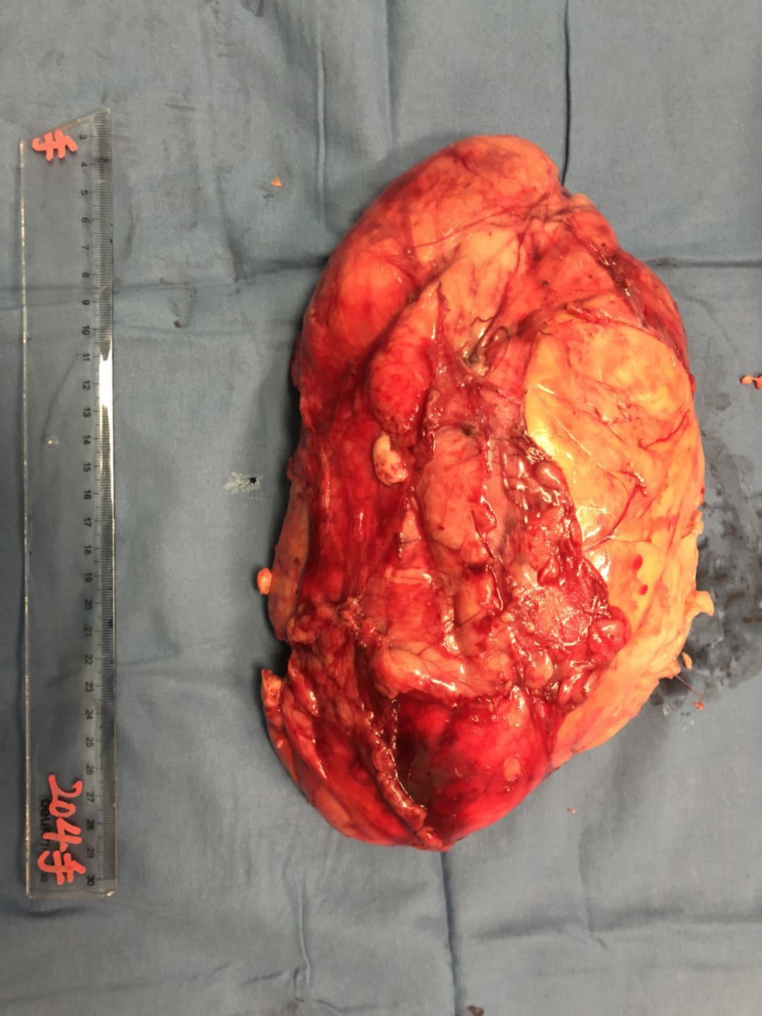 我的典型病例五:30cm巨大肾错构瘤保肾手术1例