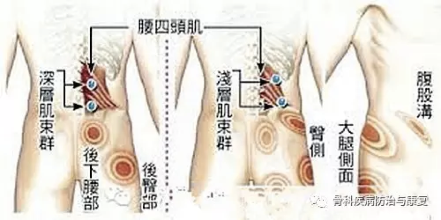 (2)臀肌筋膜炎:臀部酸痛不适,肌肉僵硬板滞,有重压感,有时皮下可扪及